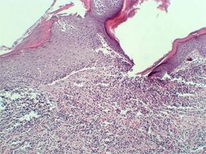 Photomicrograph (HE 100×) showing infiltrate consisting of a mixture of Langerhans’ cells and eosinophils.