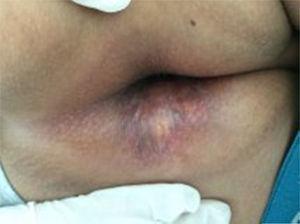 Appearance of the lesion after treatment instituted with vinblastine and local triamcinolone applications.