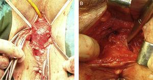 A, sublevator extrasphincteric rectal dissection by using transvaginal anterior perineal approach in a female patient; B, sublevator extrasphincteric rectal dissection by using anterior transperineal approach in a male patient.