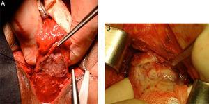 A, sublevator trans-sphincteric rectal resection by using transvaginal anterior perineal approach in a female patient; B, sublevator trans-sphincteric rectal resection by using anterior transperineal approach in a male patient.