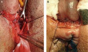 A, a full-thickness colo-anal anastomosis by using transvaginal anterior perineal approach in a female patient; B, a full-thickness colo-anal anastomosis by using anterior transperineal approach in a male patient.