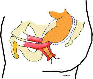 Illustration of the resection borders of the combined abdominal and perineal rectal resection operation.