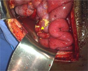 Perforated appendix involved with fibrin (arrow).