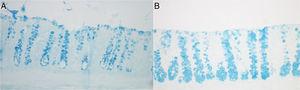 (A) Tissue expression of acidic mucins in the colonic mucosa without of an animal submitted to saline intervention for four weeks. One can note a significant reduction in the content of acidic mucins, mainly in the bottom of the colic glands; (B) tissue expression of acidic mucins in the colonic mucosa devoid of fecal stream of an animal submitted to curcumin at a concentration of 200mg/kg/day for four weeks. One can observe an increase in the content of acidic mucins, especially in the deeper regions of the colic glands (AB: 200×).
