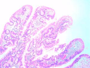 Polypoid adenoma-like dysplasia and colonic cell metaplasia.