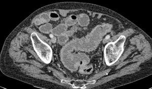 CT transverse section demonstrating irregular and asymmetrical thickening of the sigmoid colon wall. Absence of lymph node enlargement in the mesosigmoid. Suspicion of an expansive primary lesion.