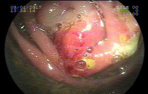 Colonoscopy revealing an expansive lesion covered with intraluminal mucosa in the sigmoid colon.