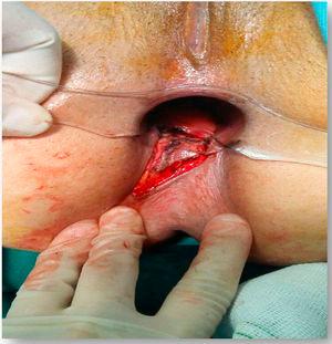 Fissurectomy and V–Y advancement flap.