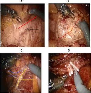 Inferior mesenteric vascular isolation (A) and preaortic dissection (B); IMA and IMV isolation (C) and transection (D). A, Opening of the peritoneum above the aorta and the right iliac artery. B, Mobilization of the Inferior Mesenteric Artery (IMA) in front of the embryologic preaortic fascial layer. C, Dissection of the IMA with preservation of the left colic artery (arteria colica sinistra). D, Clipping and transection of the IMA preserving the left colic vessel take-off.