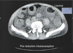 CT scan demonstrated the presence of severe edema and a lipoma of the sigmoid.