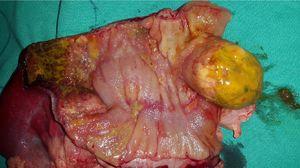 A partial colectomy and colostomy (Hartmann procedure).