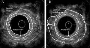 Male anal canal – middle position – regions of interest. (A) Rectal wall; (B) Mesorectal fat.