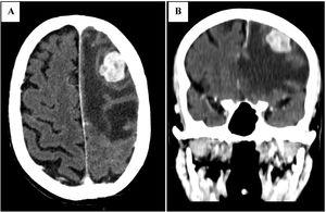 Coronal [A] and axial [B] views of the head CT scan demonstrating a single frontal metastatic lesion.