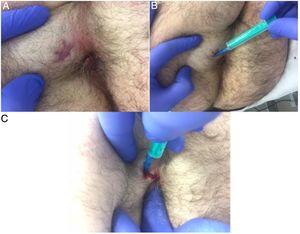 Procedure technique, external approach. Patient with an anterior transsphincteric anal fistula, lithotomy position. (A) External opening of the anal fistula. (B) Abbocath 18G catheter positioned through the external opening of the fistula. (C) The abbocath catheter is positioned through the external opening in the fistula tract, while the internal opening was sealed performing a digital rectal examination, increasing the filling pressure.