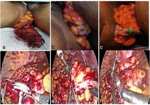 (a) Exteriorization of the rectum with the tumour through the anal canal. (b) Resection of the colon extracorporeally. (c) Inserted anvil with a purse string suture around it. (d and e) Insertion of an anvil introduced transanally through a proximal colotomy. (f) Cutting below the anvil with a linear laparoscopic stapler.