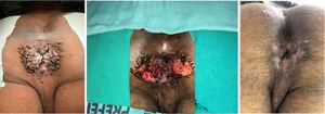 Extensive perianal lesion refractory to topical clinical treatment; second surgery; and current final aspect.