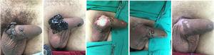 Condylomatous lesion on genitalia; application of podophyllin 25%; surgical excision; operative aspect; and current aspect.
