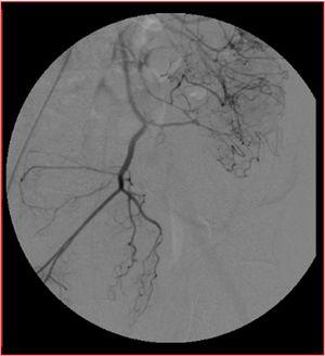 Inferior mesenteric artery (IMA) angiogram.
