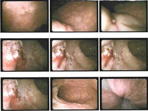 Control colonoscopy. A small scar area is observed in the rectum; a mucosectomy and enlargement of the biopsy in the submucosal layer were performed.