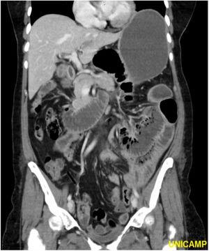 CT with reformatted image. Coronal section where ascending vessels are identified, strongly grouped, indicating mesocolon defect level, with multiple redundant loops of the small intestine in the upper left quadrant. It is also evidenced intestinal obstruction with segmental dilatation and liquid stasis proximal to the obstruction site.