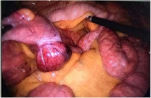 Laparoscopic image of the stromal lesion located in the first jejunal portion.