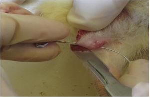 Scalpel fistulotomy.