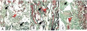 Photomicrography demonstrating the presence of fibrosis. (A) Animal from the fistulotomy group; (B) animal from the polypropylene group; (C) animal from the polyglactin group; black arrows, collagen fibers and red arrows, neoformation of blood vessels (Gomori trichrome – GT, 20×).