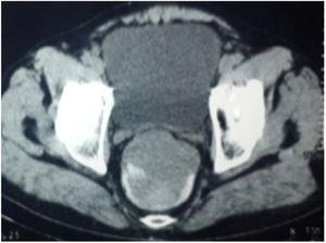 Preoperative CT scan of rectal GIST.