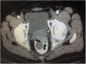 Preoperative CT scan after imatinib therapy showing a reduction in the size of rectal GIST compared to previous CT scan.