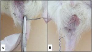 (A) Transection of the anal sphincter with steel wire; (B) Steel wire positioned to create a fistula.