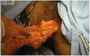 Transanal surgical specimen removal.