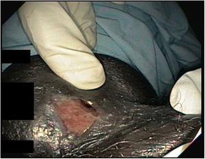 Fistulous orifice with perianal ulcer in a patient with mycobacterial infection.