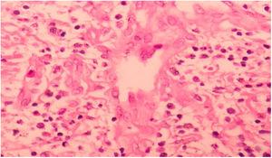 Photomicrograph (200×), HE stain, showing dermis with acute inflammatory infiltrate and multinucleated giant cell in the center.