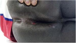 Late postoperative period of patient with anal fistula related to mycobacterial infection. Patient was treated for 6 months with tuberculostatics.