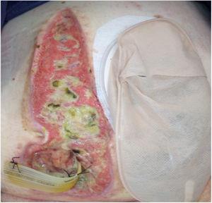Photo demonstrating drainage of abscess secondary to rectal stump leak via insertion of a corrugated drain through the lower aspect of laparotomy wound.