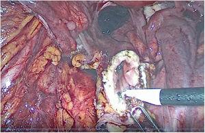 Cutting the rectum stump with cautery.