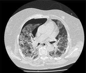 Computed tomography image showing alveolar interstitial infiltrate and right pneumothorax.