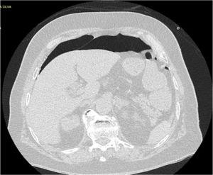 Computed tomography image showing extensive pneumoperitoneum.