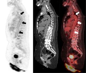 Cortes sagitales PET (izquierda), TC (centro) y fusión PET/TC (derecha) que muestran un aumento patológico difuso del metabolismo glicídico en la pared de la aorta, sugerente de vasculitis de gran vaso (flechas). Maximum standarized uptake value (SUVmáx) aorta 4,91; SUVmáx hígado 4,52.