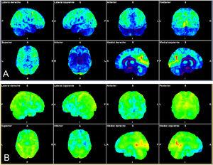 Paciente con perfil de autoinmunidad (antecedentes de sacroileitis, uveítis, sensibilidad al gluten). Infección por SARS-CoV-2 leve con pérdida progresiva de memoria a corto plazo, déficit atencional y astenia importante. Se muestran los mapas estadísticos de superficie cerebral obtenidos mediante análisis automatizado (Syngo.via Neurology; Siemens). Imágenes con normalización a cerebro entero (A) y análisis comparativo con la base de datos ajustada a la edad de la paciente (B) que muestran hipometabolismo frontal (frontorbitario, circunvolución recta y circunvolución inferior) temporal bilateral (amígdalas e hipocampos), en ambos tálamos, tronco y relativo de ambos hemisferios cerebelosos.