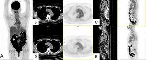 Paciente con malestar general y pérdida de peso y elevación de PCR tras COVID-19 leve. En seguimiento por cuadro polimiálgico como presentación de entesopatía HLAB27+. MIP (A) que muestra incremento difuso de la captación intestinal que se atribuye al tratamiento con antidiabéticos orales y leve captación hiliar bilateral y de la aorta torácica. Cortes axiales (B) y sagitales (C) de TC y PET que muestran incremento de la captación en pared de aorta, no visible en estudio previo realizado por el cuadro reumatológico (D, E).