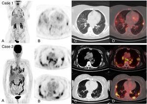 Acute infection by SARS-CoV-2 detected during an 18F-FDG-PET/CT study in 2 asymptomatic patients from a respiratory and infectious point of view, later confirmed by RT-PCR. Case 1. MIP (A) of a patient with diffuse large cell B lymphoma in complete metabolic response showing multiple pulmonary uptakes also visible in the axial PET slice (B) and corresponding to ground glass opacities in the axial CT (C) and PET/CT slices (D). Case 2. MIP (A) of patient followed for melanoma showing intense pulmonary and hilar mediastinal uptake corresponding to bilateral ground glass opacities of peripheral predominance and mediastinal and hilar adenopathies visible in the PET (B), CT (C) and PET/CT tomographic slices (D).