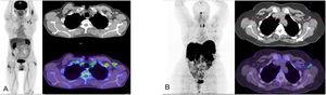 (A) 18F-FDG PET/CT study in a patient who had received the first dose of Vaxzevria 5 days previously. The MIP image shows focal uptake in the area of the injection site in the left arm and ipsilateral axillary adenopathies localized at levels I and II in the axial CT and PET/CT slices. (B) 68Ga-edotreotide (Somakit-TOC) PET/CT study in a patient who had received the second dose of Vaxzevria 15 days previously. The MIP image shows uptake in the left axilla corresponding to adenopathies at the left axillary level I, visible in the axialCT and PET/CT slices.