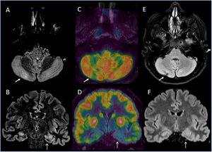 Axial (A) and coronal (B) slices of diagnosis FLAIR weighted MR imaging. Axial (C) and coronal (D) slices of FDG PET corregistered with MRI software fusion (Xeleris, GE) that shows a left temporal asymmetry metabolic activity including the hippocampal area and hypometabolism defect in the right cerebellar hemisphere (arrows). Axial (E) and coronal (F) follow up MRI show a regional infarct involving the right cerebellar cortex.