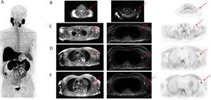 Whole-body MIP image (A). Selected axial PET/MRI images: T2 MRI, diffusion MRI sequence, [18F]F-Choline. Clavicle fossa (B). Axilla (C–E). Infracentimetric lymph nodes, with [18F]F-Choline uptake and diffusion restriction, found in left clavicle fossa and at the three levels of the left axilla.