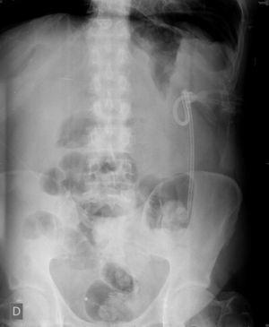 Neumoperitoneo en radiografía simple de abdomen.