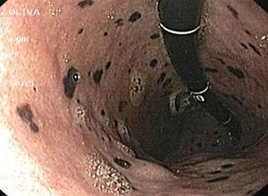 Gastric melanosis. Hyperchromic sub-epithelial plaques in the gastric body and fundus can be observed.