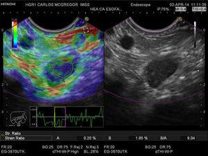 Quantitative EUS-EG of the celiac lymph node. Strain ratio (SR) measurement is shown in the left window. The two areas within the yellow circles correspond to area A (the greatest possible lymph node surface area) and area B (normal adjacent tissue in red); they are shown as percentages at the lower portion of the film. The calculated SR is shown as B/A to the lower right.