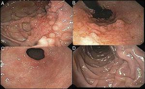 A) Gastric mucosa with limited compliance due to the scarring effect with the formation of false diverticula. B) Retrograde view of the gastric chamber showing the «paved» mucosal pattern. C) Open pylorus, with patchy mucosal erythema. D) Normal duodenum.