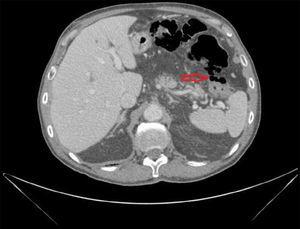 An urgent abdominal computerized tomography scan revealing free intraperitoneal gas, especially in the left flank, with duodenal wall thickening.